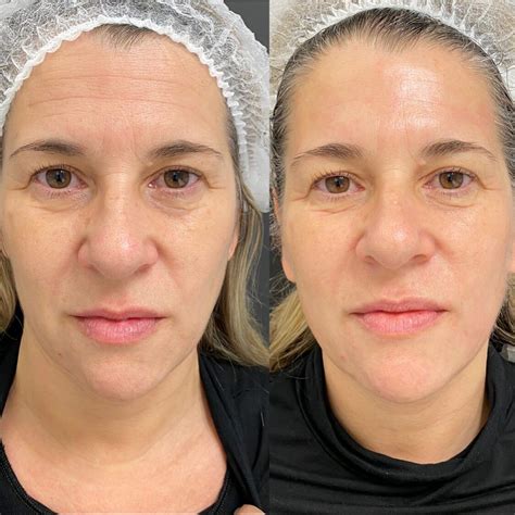 faja facial antes y después
